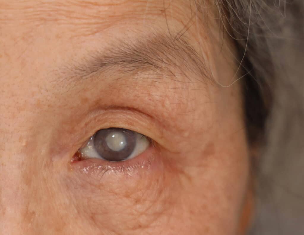 Eye with a cloudy cataract