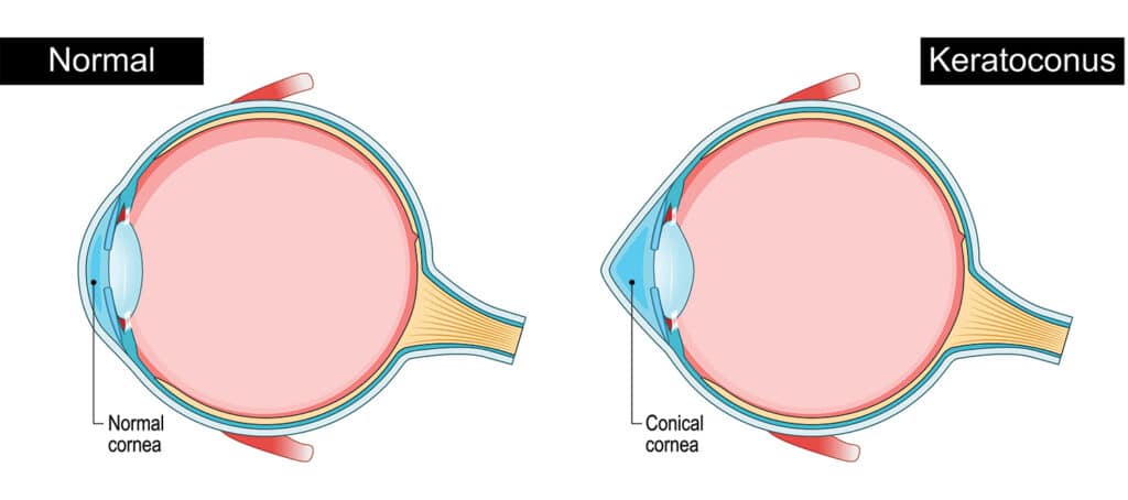 Keratoconus Diagram