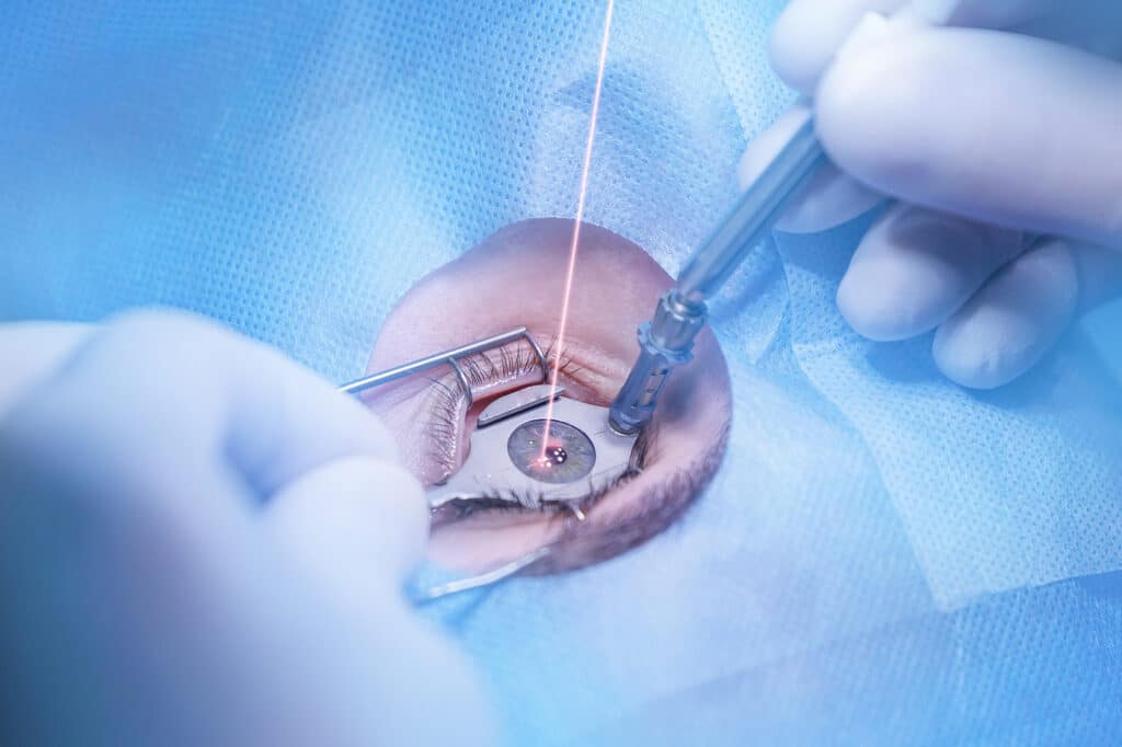 PRK Eye Surgery