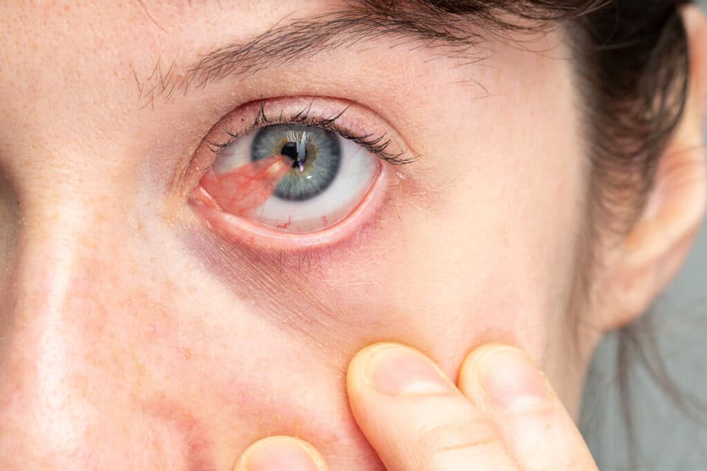 Eye with Pterygium