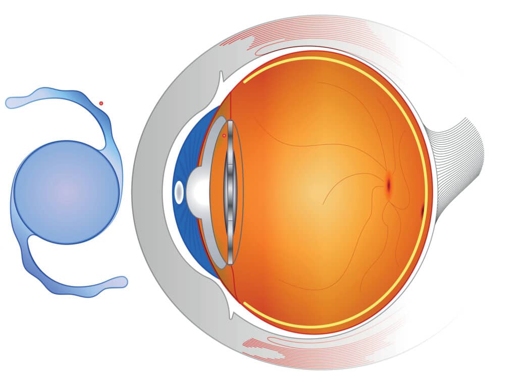 Refractive Lens Exchange (RLE)