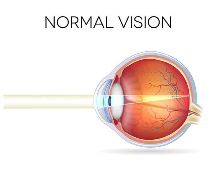 Normal Vision