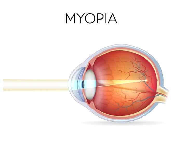 myopia diagram