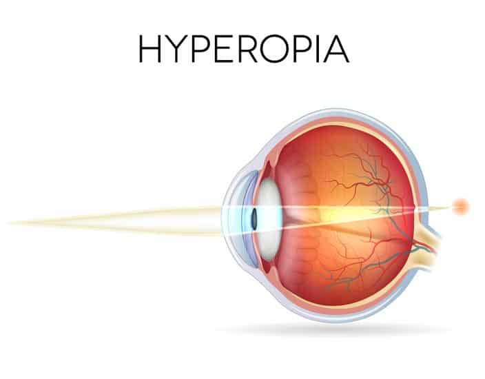 hyperopia diagram