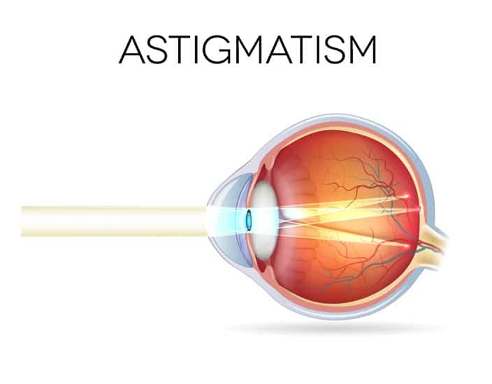 Astigmatism Diagram