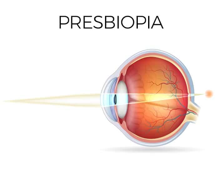 Presbyopia